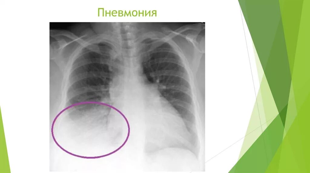 20 процентов легких. Пневмония 70% поражения легкого. Поражение легких при пневмонии. Пневмония на рентгене. Снимок поражения легких.