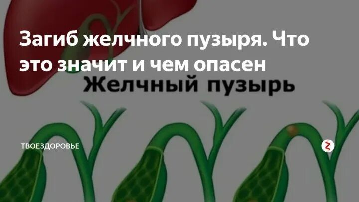 Перегиб желчного пузыря форум. Перегиб желчного. Загиб желчного. Загиб желчи.