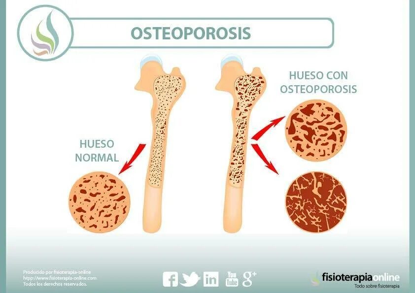 Остеопороз грудного отдела. Остеопороз и остеомаляция. остеомаляция и остеопороз разница.