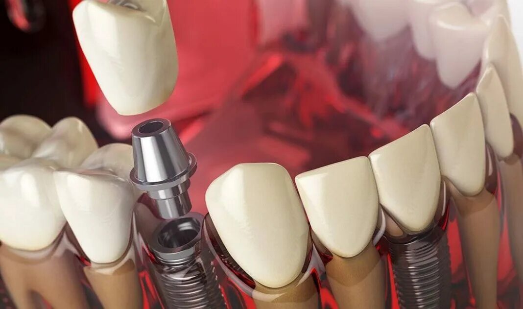 Результат установки зубного имплантата. Материал биоосс Осстем. Канье Уэст установил на зубы титановые импланты. Стоит ли ставить зубные импланты в возрасте старше 60 лет?. 3 зуба установить