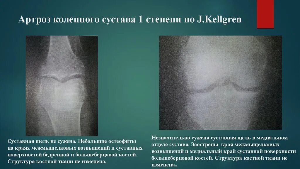 Коленный сустав по стадиям. Деформирующий артроз коленного сустава рентген степени. Остеоартроз коленного сустава 1 степени рентген. Артроз коленного сустава 1 степени рентген. Артроз тазобедренного сустава 1 степени рентген.