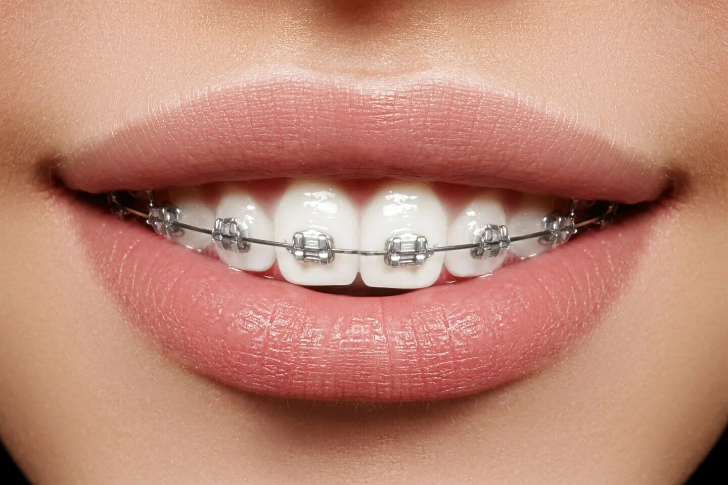 Brackets photo