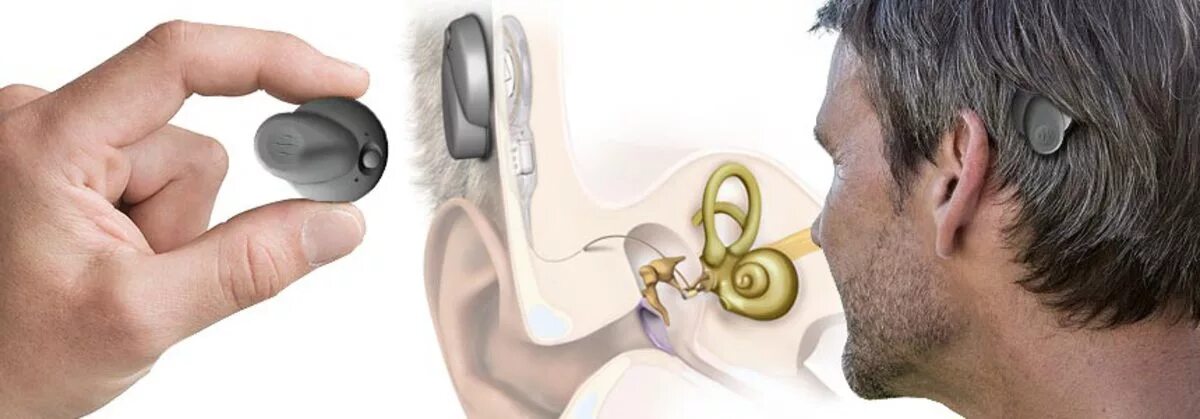 Операция на ухо на слух. Аппарат Cochlear кохлеарный Cochlear. Аппарат для глухих кохлеарная имплантация. Слуховой аппарат костной проводимости ponto. Кохлер слуховой аппарат.