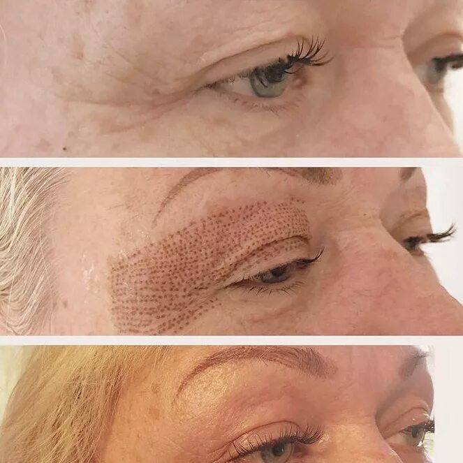 Омоложение холодной плазмой. Холодная плазма для лица фото. Plazma отзывы. Холодная плазма в косметологии для лица. Plazma отзывы.