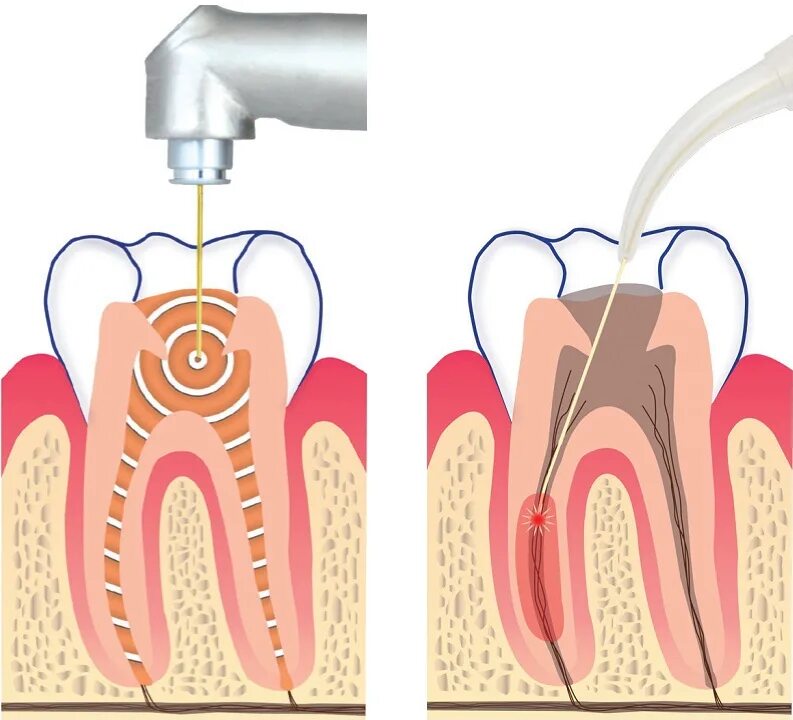 Витальная экстирпация пульпы. Лазерное препарирование кариеса зубов. Пульпит витальная экстирпация. Лазерный метод препарирования. Препарирование корневого канала