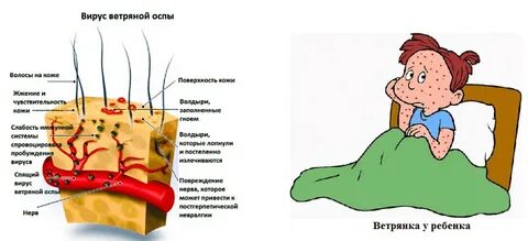 Ветряная оспа осложнения