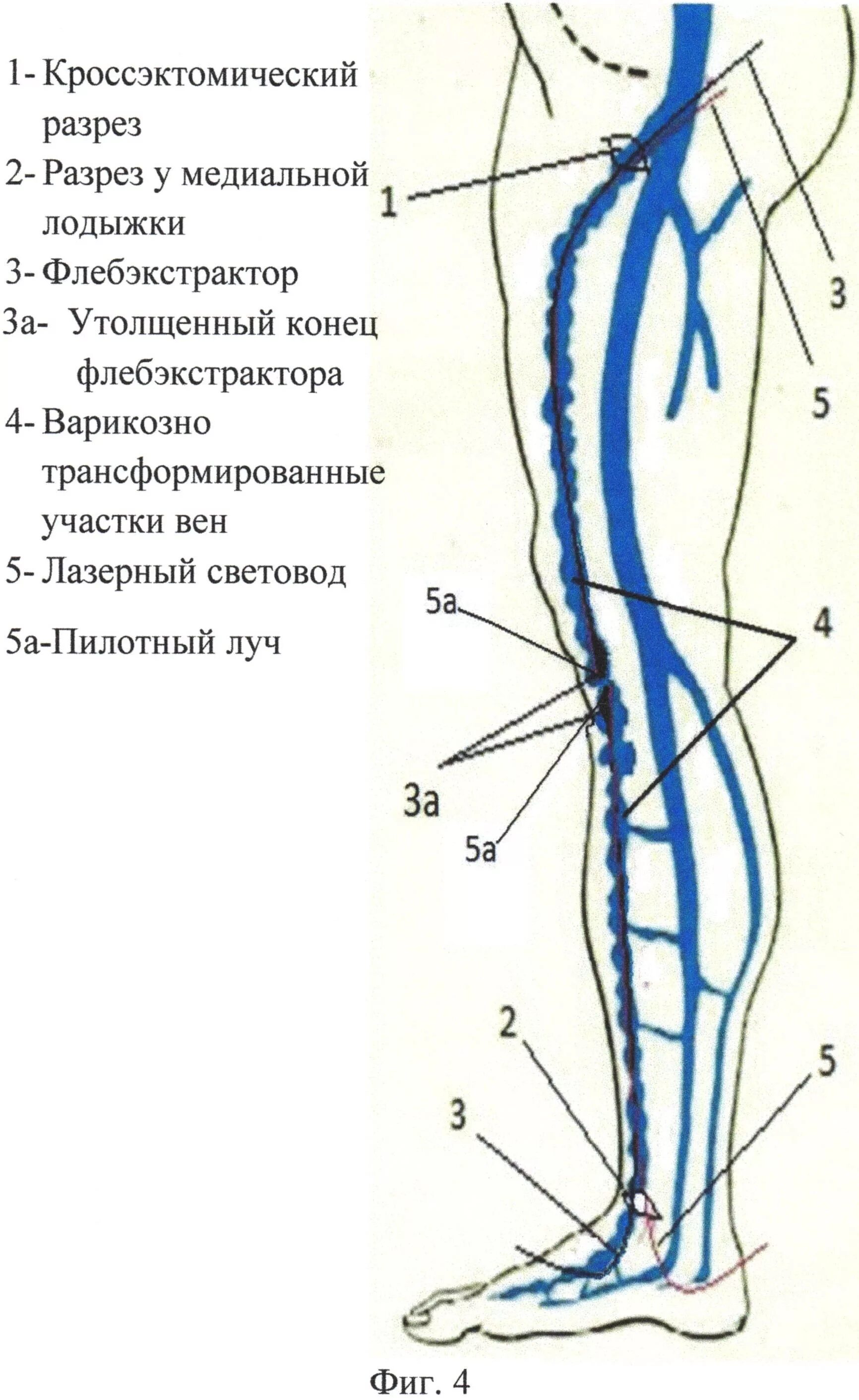 Большая подкожная Вена ноги анатомия. БПВ вен нижних конечностей анатомия. Большая подкожная Вена ноги притоки. Правая подкожная вена