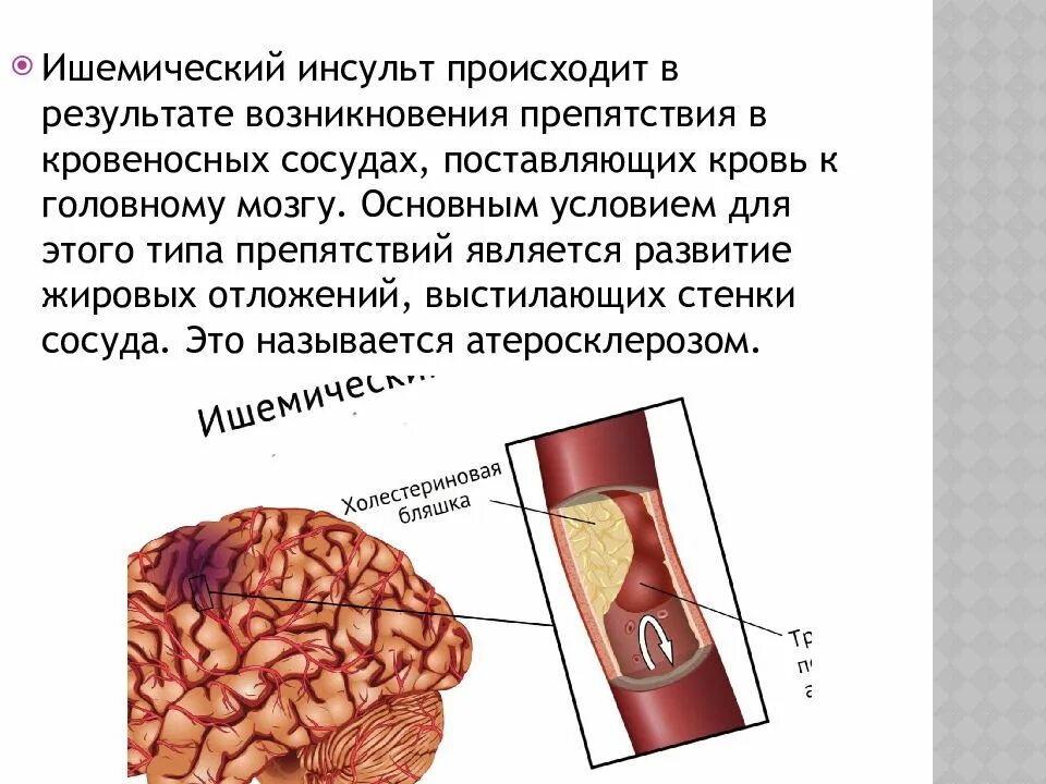 Инсульт. Мришемического и нсульта. Ишемический инсульт ишемический.