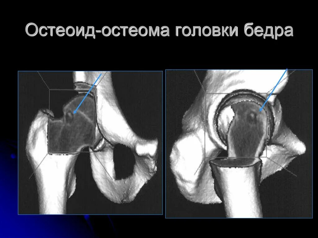 Остеома плечевой кости рентген. Остеома шейки бедренной кости. Остеома бедра. Губчатая остеома бедренной кости. Остеоид-остеома  1 плюсневой кости.