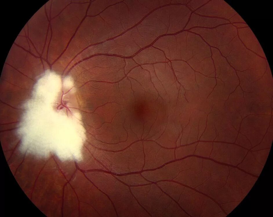 Аномалия развития зрительного нерва. Миелиновые волокна ДЗН. Миелиновые волокна зрительного нерва. Глазное дно миелиновые волокна. Миелиновые волокна в глазу.