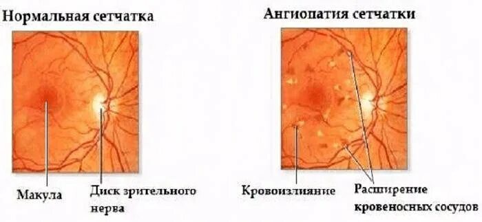 Ангиопатия сосудов мкб. Ангиопатия сетчатки жалобы. Ангиопатия ретинальных сосудов. Клиника гипертонической ангиопатии сетчатки.