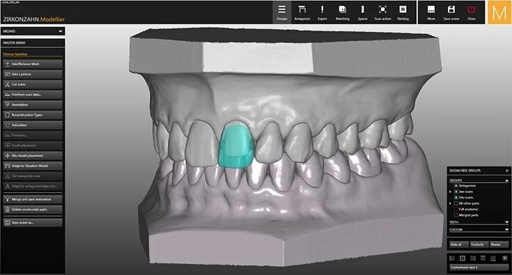 Cad cam моделирование. Восковое моделирование. моделирование коронки cad cam. wax up восковое моделирование.