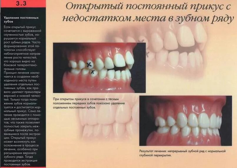 Как проверить прикус. Гнатическая форма открытого прикуса. открытый фронтальный прикус. передний открытый прикус.
