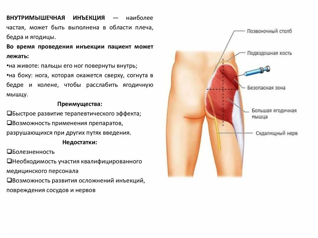 Методы уколов. Общая методика инъекций. Методика введения внутрисуставных инъекций. Z-методику для внутримышечных инъекций рисунок.