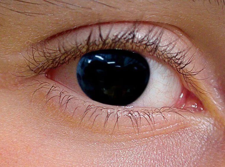 Как называется болезнь зрения. Аниридия отсутствие Радужки. Патология глаз аниридия.