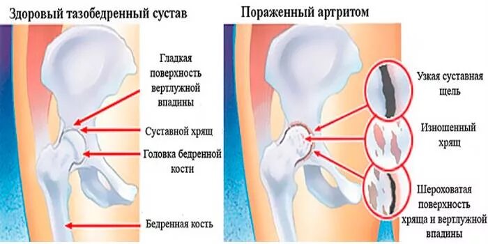 Боль в бедренном суставе. Локализация боли в тазобедренном суставе. Воспалённый тазобедренный сустав. Причина боли в правом тазобедренном суставе