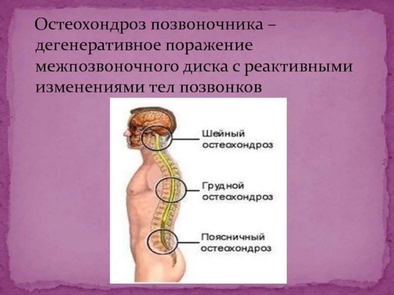 Дегенеративные поражения позвоночника. Остеохондроз позвоночника. Позвонок остеохондроз. Остеохондроз кратко и понятно.