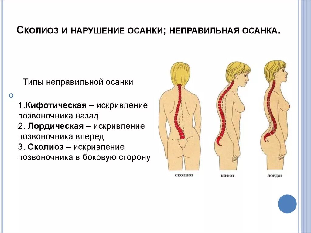 Нарушение изгиба позвоночника. Сколиоз позвоночника виды искривления позвоночника. Таблица типов искривление позвоночника. Сколиокифотическая осанка. Нарушение осанки кифоз сколиоз.