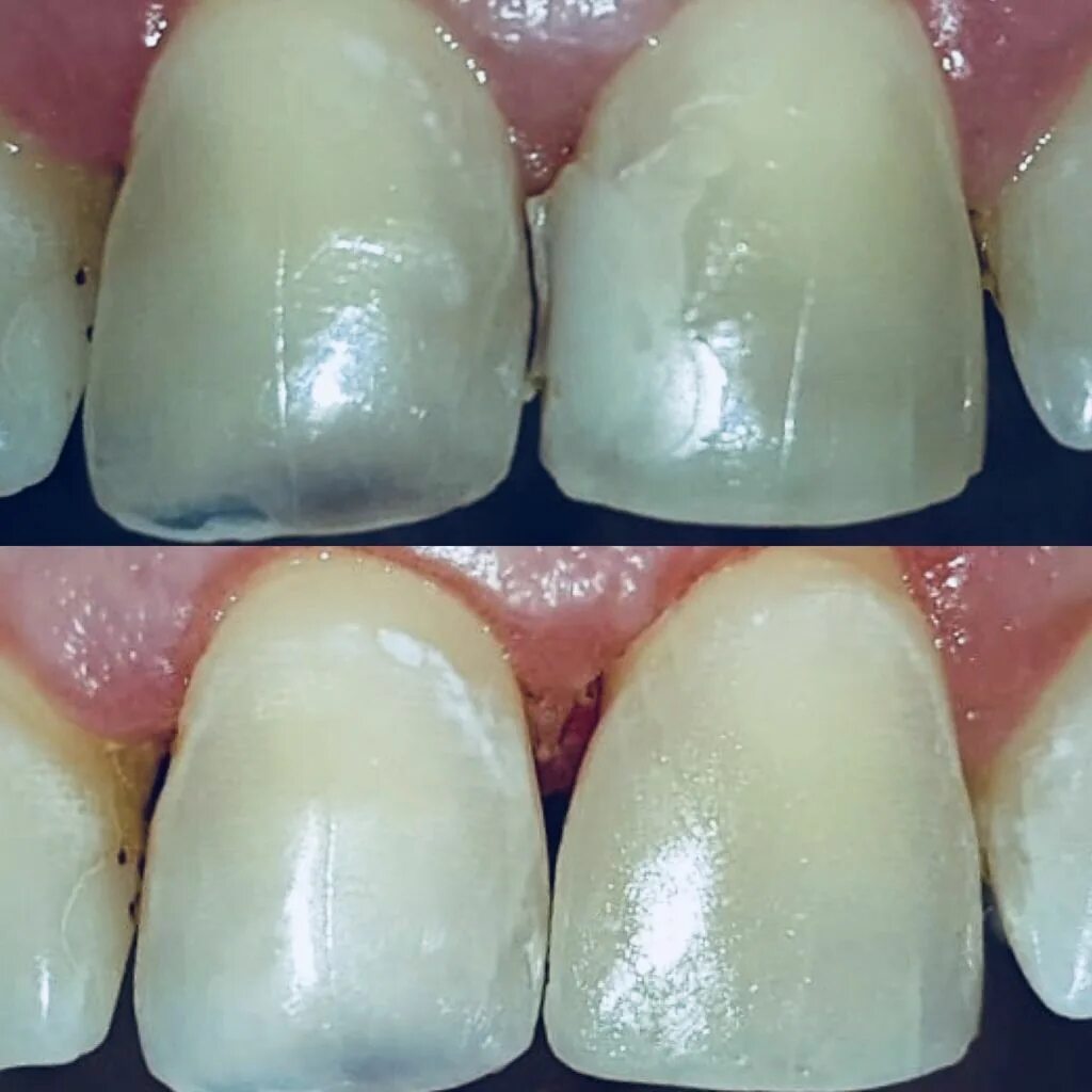 Наращивание зубов композитными материалами. Восстановление зубов композитными материалами. Восстановление передних зубов композитом.