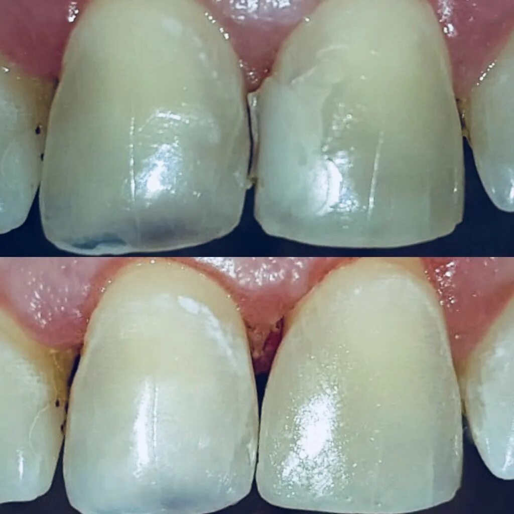 Прямые реставрации зубов композитом - Dental Magazine