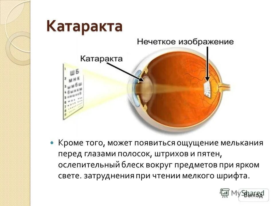 Почему вижу полоски. Катаракта нечеткое изображение. Вспышки в глазу сбоку причины. Молния перед глазами сбоку. Полоски перед глазами.