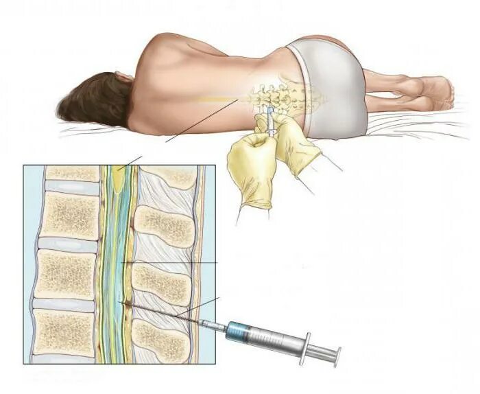 Эпидуралка болит спина. Спинномозговая пункция схема. Взятие спинномозговой жидкости. Пункция спинномозговой жидкости.