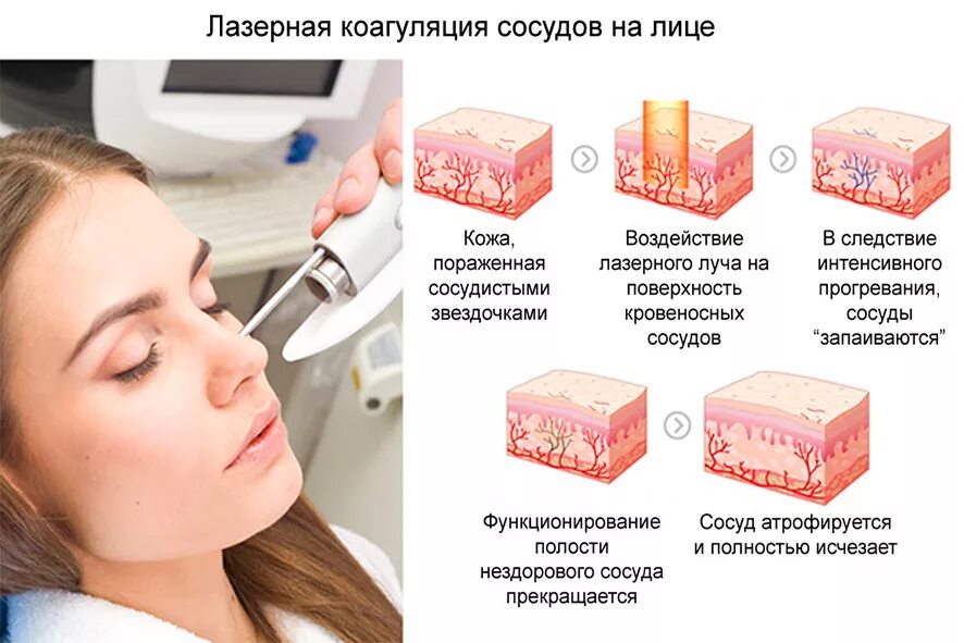 Лазерное воздействие на кожу skinlift ru. Лазерная коагуляция сосудов. Лазерная фотокоагуляция сосудов. Коагуляция сосудов на лице лазером. Фотокоагуляция сосудов на лице.