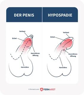 entzündung penis - www.ermcgs.com 