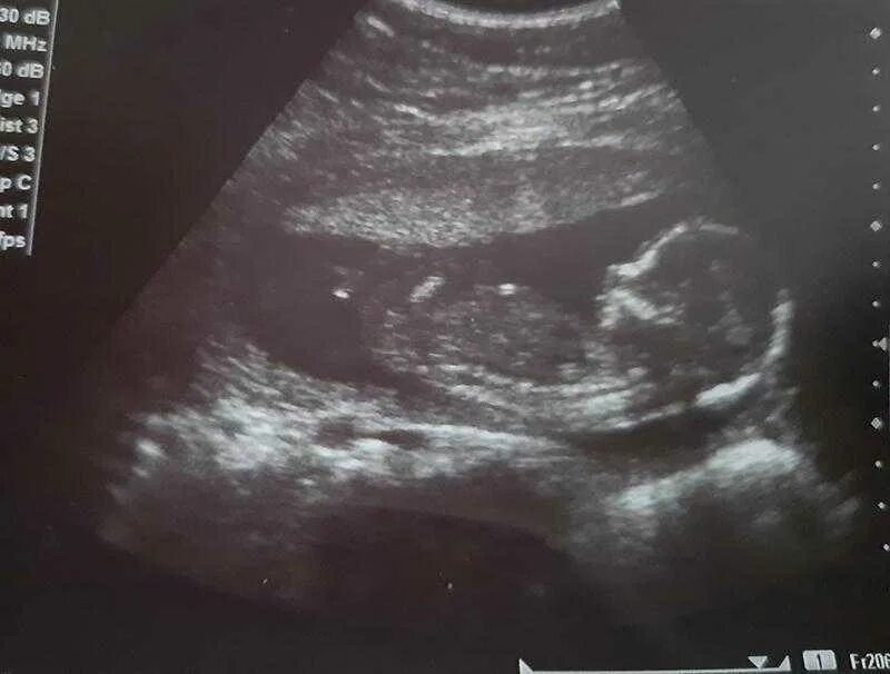 Малыш на 17 неделе беременности. Плод ребенка на 17 неделе беременности. 17 Недель беременности двойня фото.