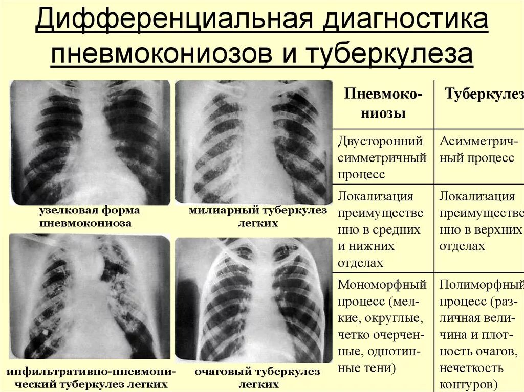 Дифференциальный диагноз силикоза. Дифф диагностика пневмокониоза и туберкулеза. Дифференциальный диагноз силикоза и туберкулеза. Пневмокониоз легких 1 стадия рентген. Диагноз с 2 легкого