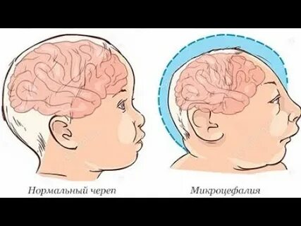 Симптомы микроцефалии у детей
