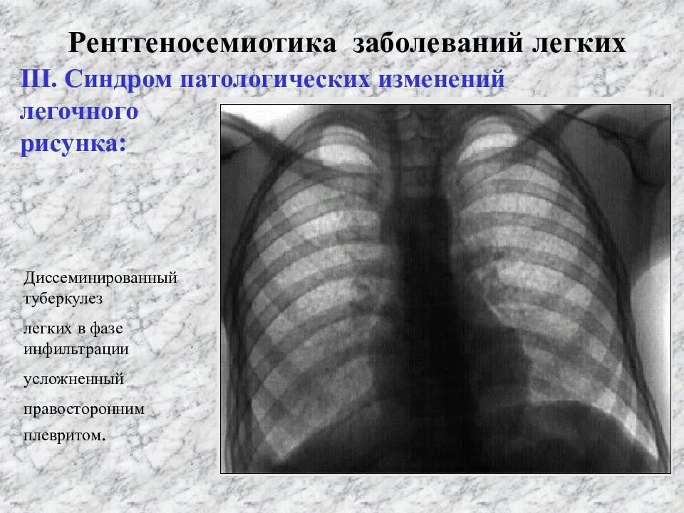 Диссеминированный туберкулез фаза инфильтрации. Диссеминированный туберкулез флюорография. диссеминированный туберкулез рентгенологические синдромы. диссеминированный туберкулёз лёгких рентген. синдром патологии легочного рисунка туберкулез.
