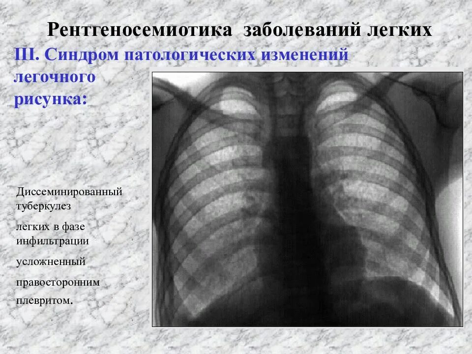 Диссеминированный туберкулез фаза инфильтрации