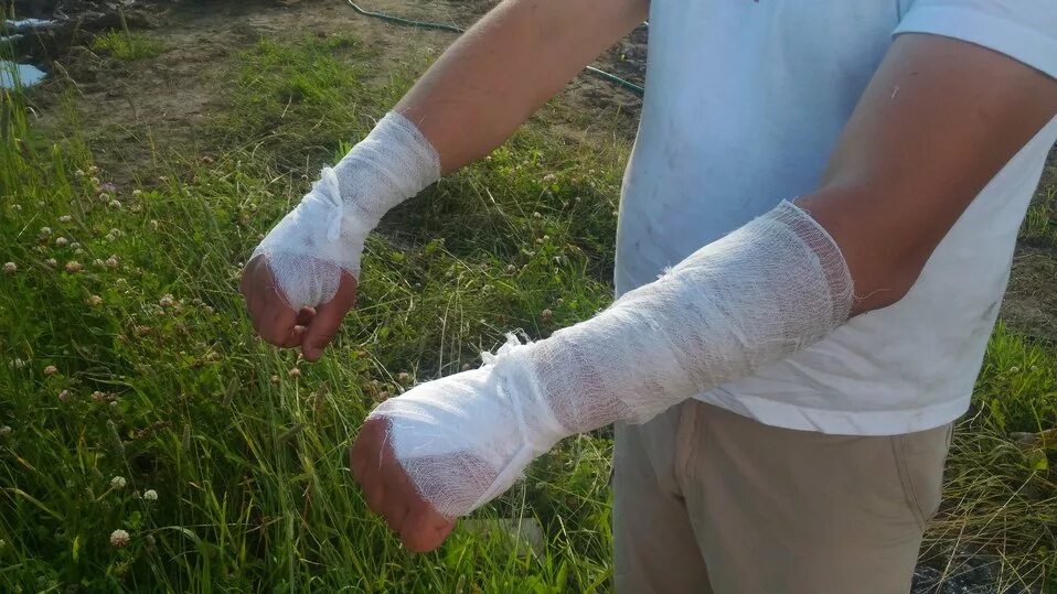 Чем намазать ожог от борщевика. Ожог борщевиком первая помощь. Мазь от ожога борщевиком. Борщевик сосновского ожоги. Фотохимический ожог борщевик.