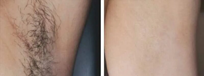 How to remove pubic hair at home Shave Your Private Hair or Bikni Area Fast - Yo