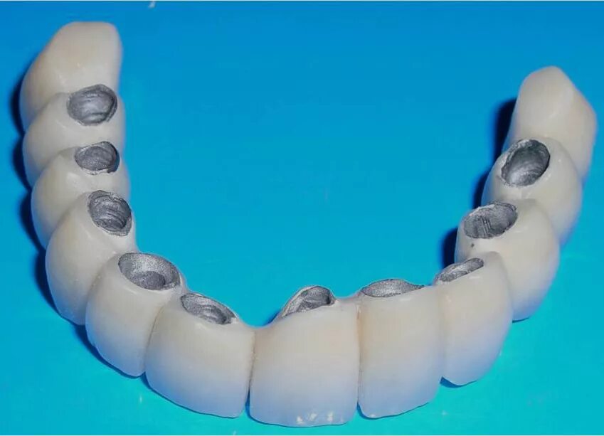 Сколько стоит металлические зубы. Металлокерамическая коронка а1. Коронка металлокерамика 6 зуб. Металлокерамика мостовидные протезы. Металлопластмассовый мостовидный протез.