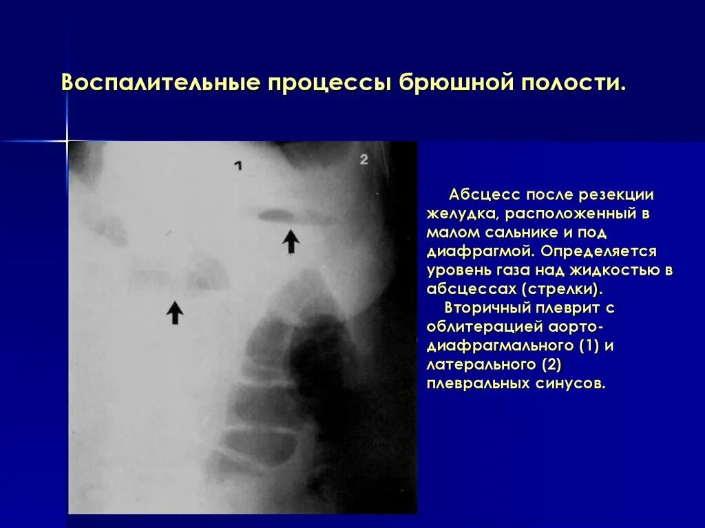 Абсцесс брюшной полости. Абсцесс брюшной полости рентген. Локализация абсцессов брюшной полости. Типичные места локализации абсцессов в брюшной полости. Наличие гноя в брюшной полости