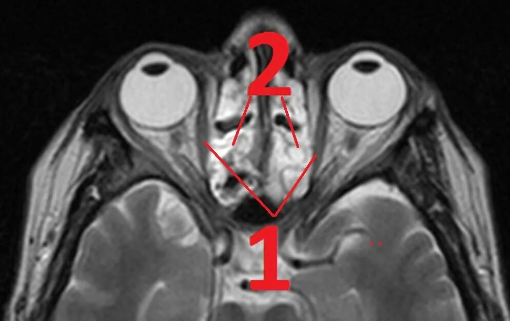 Мрт глазного нерва. Атрофия зрительного нерва мрт. Неврит зрительного нерва мрт. Патология зрительного нерва мрт. Экзофтальм на кт.