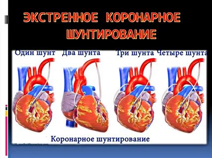 Операция коронарный сосуд