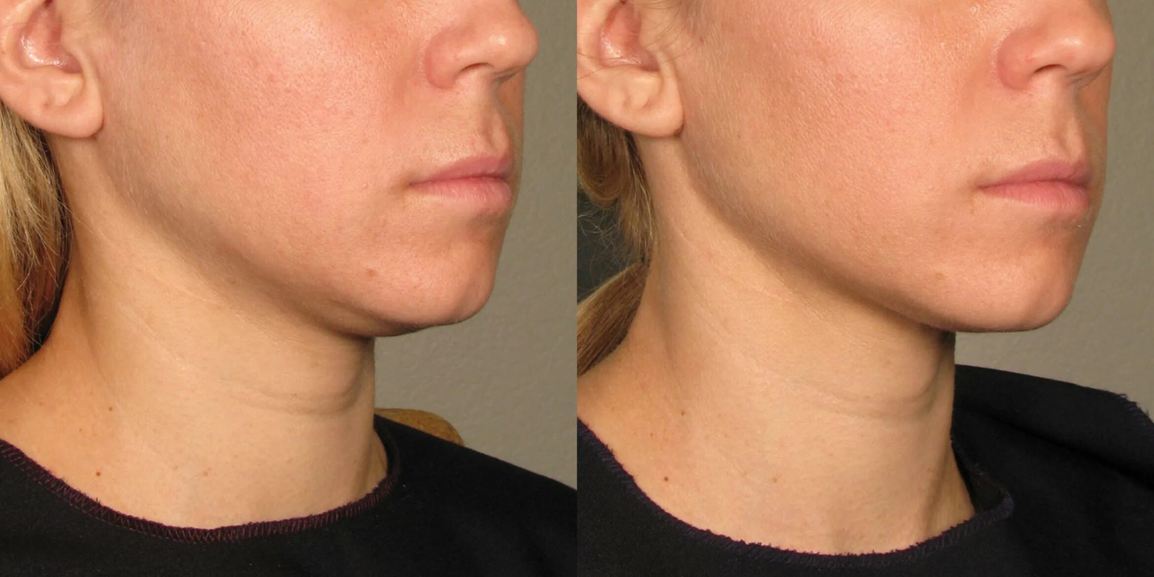 брыли (лифтинг нефертити). липолитик в подбородок до и после. липолитики в подбородок. второй подбородок. мезотерапия подбородка.
