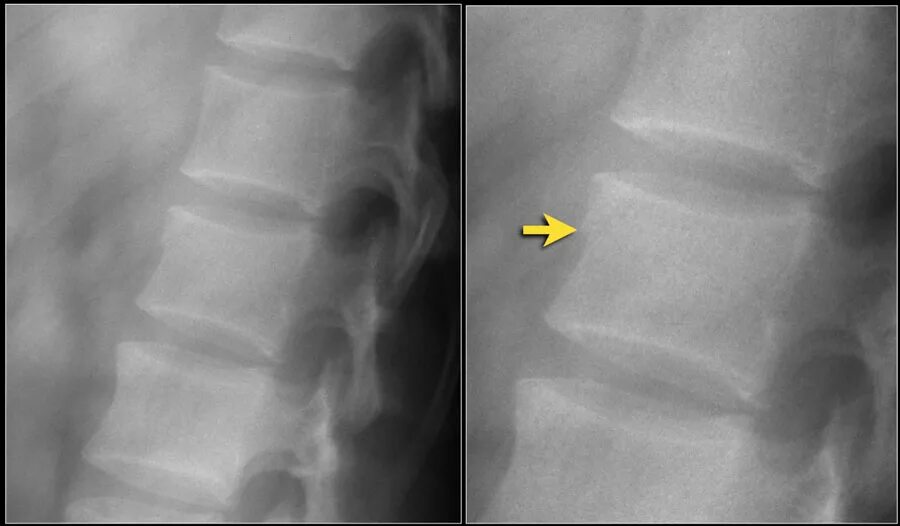 Ребенок сломал позвоночник. Компрессионный перелом l1 l2 позвонков. Компрессионный перелом l1 позвонка. Компрессионный перелом позвоночника грудного отдела у детей рентген. Компрессионный перелом позвоночника th11-l1.