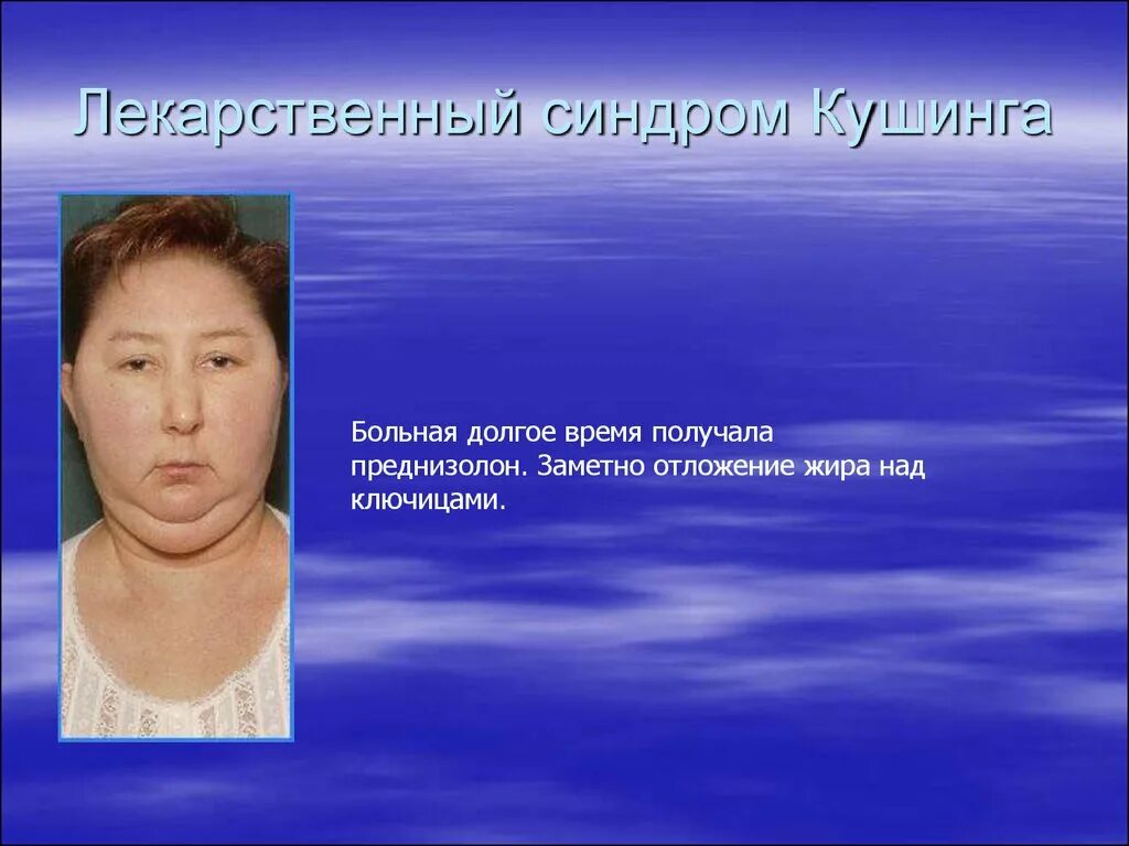 Преднизолон синдром кушинга. Лекарственный синдром кушинга. гипертрихоз иценко кушинга. синдром кушинга преднизолон. синдром кушинга после преднизолона.