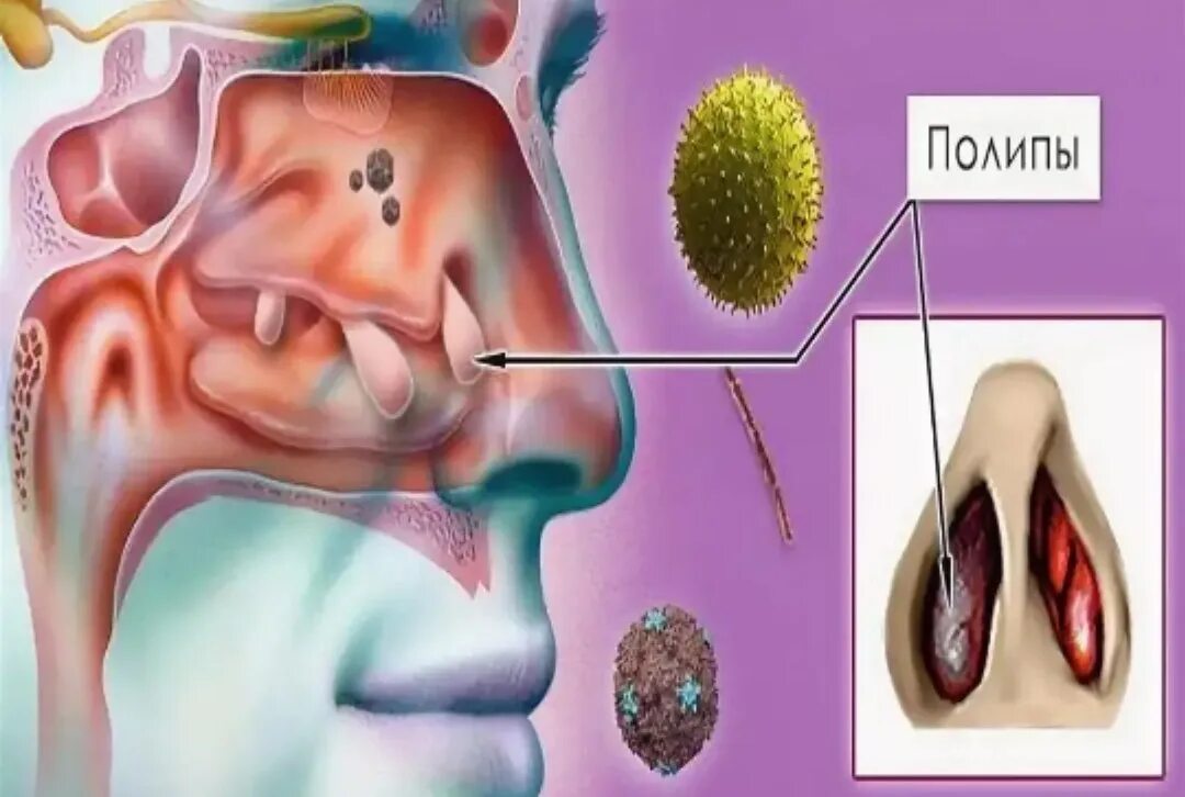 Аденотомия схема операции. Эндоскопия носоглотки аденоиды. Полипозный риносинусит эндоскопия. Воспаление глоточной миндалины (аденоидит). Вазомоторный ринит нос.