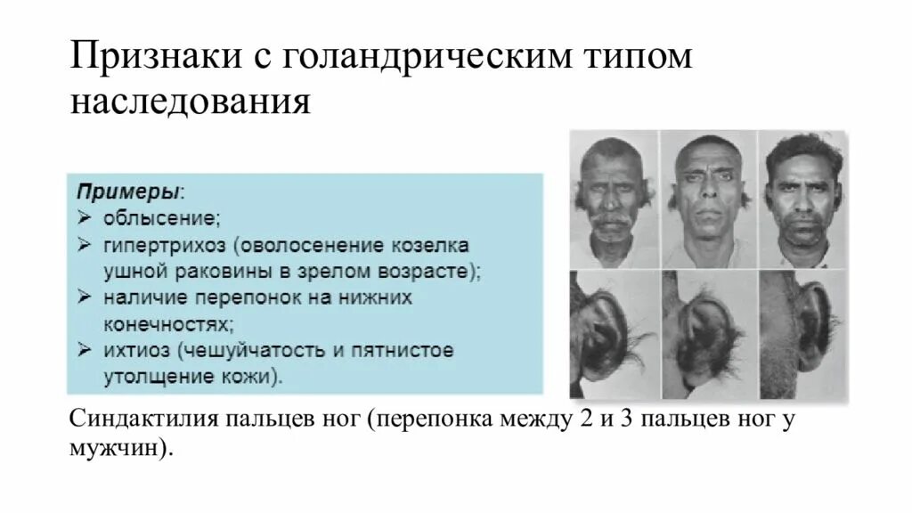 Заболевания сцепленные с y хромосомой. Голандрический Тип наследования. Гипертрихоз голандрический Тип наследования. Голандрический Тип наследования признаков. Y-cцепленный (голандрический) Тип наследования.