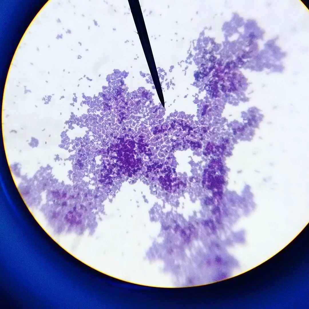 Стафилококк ауреус микроскоп. Стафилококкус ауреус микроскоп. Стафилококк ауреус микроскопия. Стафилококк ауреус мазок.