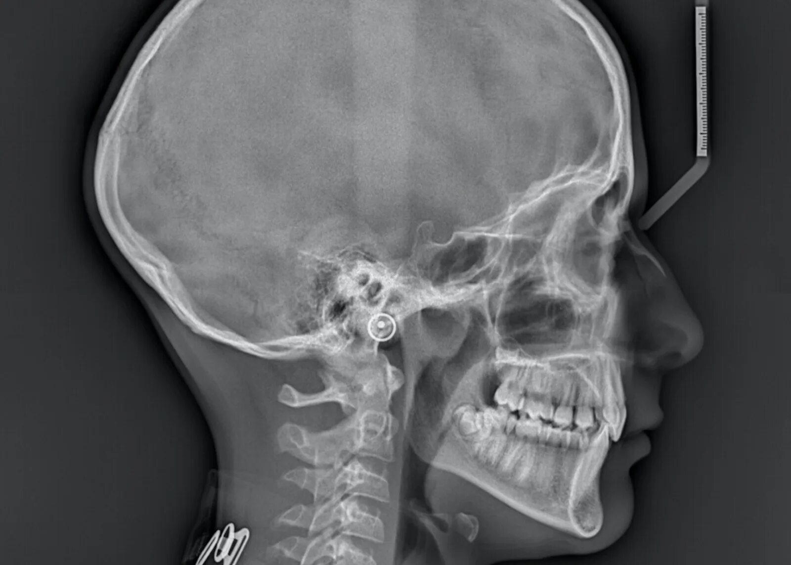 Рентген можно сделать. Телерентгенограмма черепа (ТРГ).