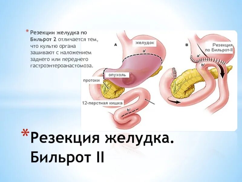 Умер от резекции желудка. Резекция желудка по Бильрот 1. Оперированный желудок Бильрот 2. Операции Бильрот 1 и Бильрот 2.