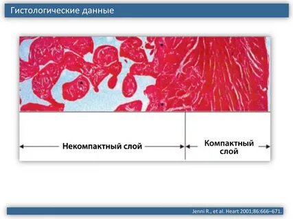 Некомпактный миокард