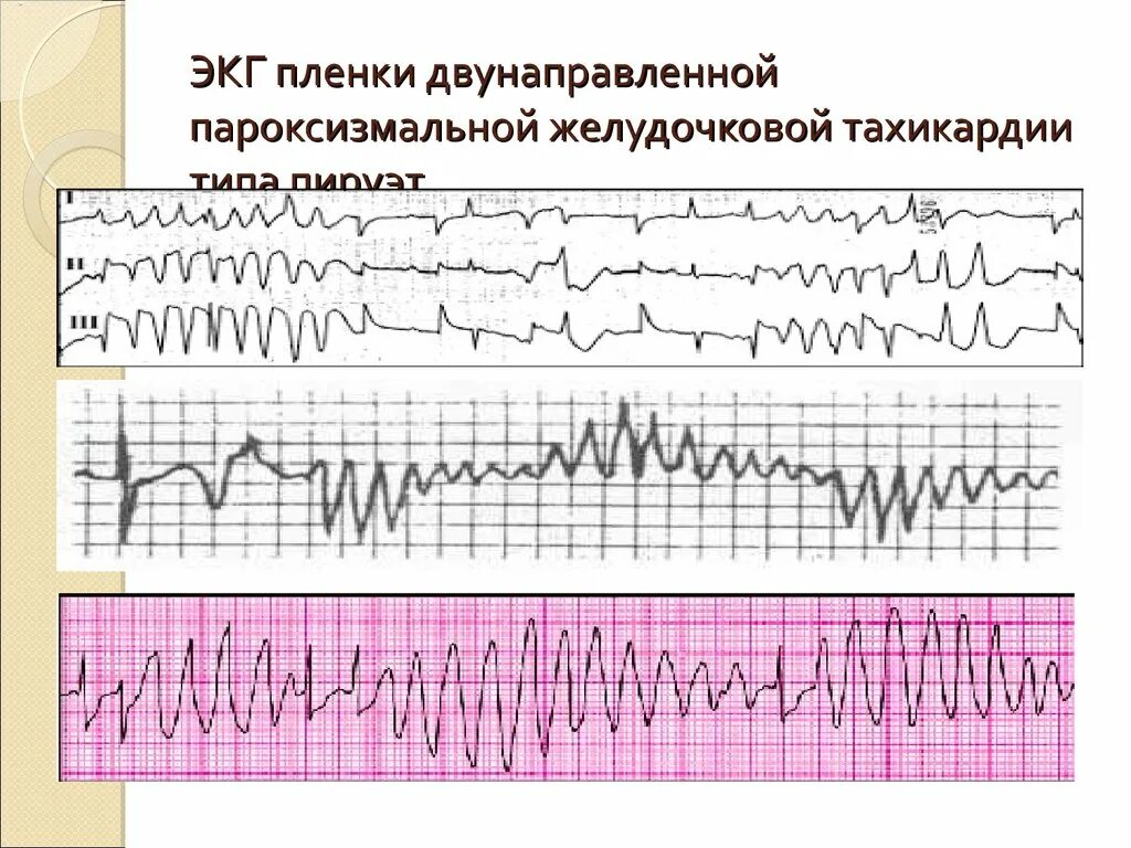 Желудочковая тахикардия на экг. Пароксизмальная желудочковая тахикардия на ЭКГ. ЭКГ при желудочковой пароксизмальной тахикардии. Пленка ЭКГ аритмия пароксизмальная. Веретенообразная желудочковая тахикардия ЭКГ.