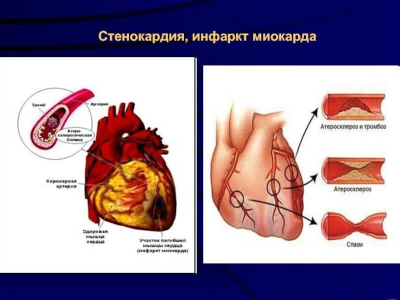 Ишемическая болезнь сердца симптомы. Ишемия коронарных сосудов. Ишемическая болезнь сердца симптомы. Ибс стенокардия инфаркт. Основные причины ишемической болезни сердца.